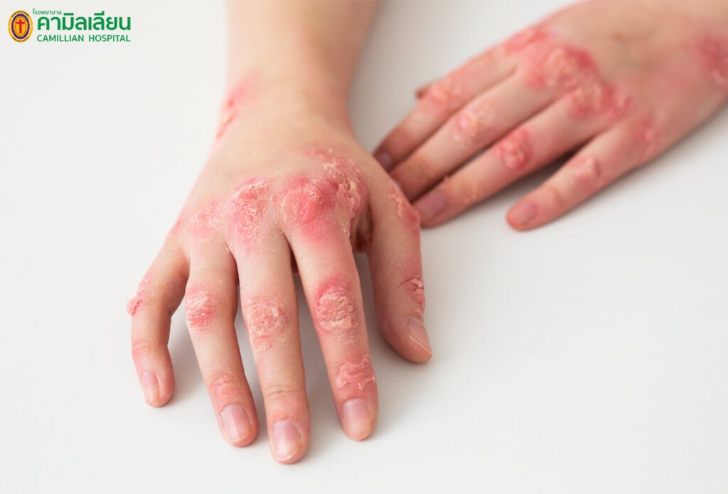 “โรคงูสวัด” เป็นแล้วต้องรักษา